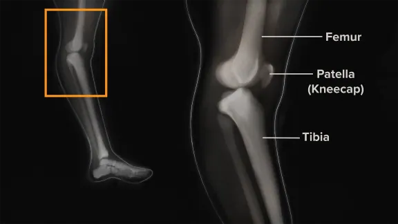 Knee Hyperextension